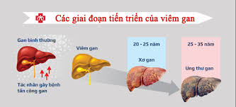 Các giai đoạn của viêm gan siêu vi