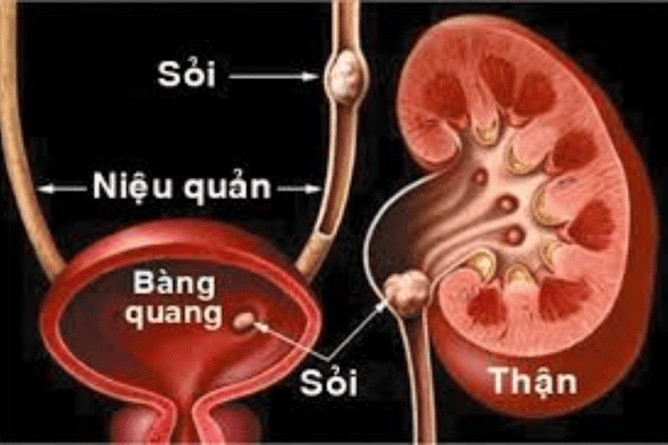 Bệnh gây hình thành sỏi trong hệ thống tiết niệu