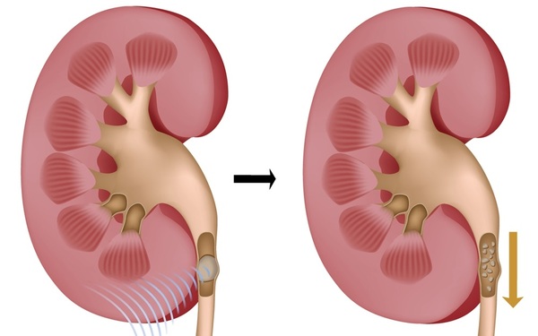 Ăn uống có vai trò rất lớn trong  điều trị và phòng ngừa sỏi tiết niệu