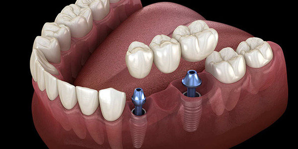 Chế độ ăn hợp lý giúp bảo vệ Implant