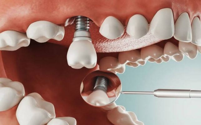 Chi phí 1 chân răng nhân tạo Implant