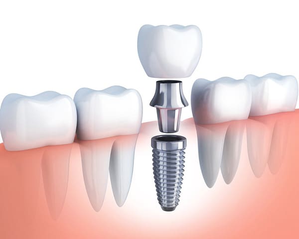 Răng Implant bền bao lâu còn tùy thuộc vào nhiều yếu tố