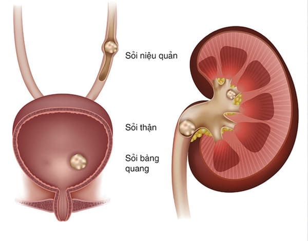 Sỏi niệu quản là gì?