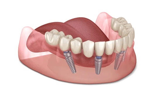 Trồng răng Implant là gì?