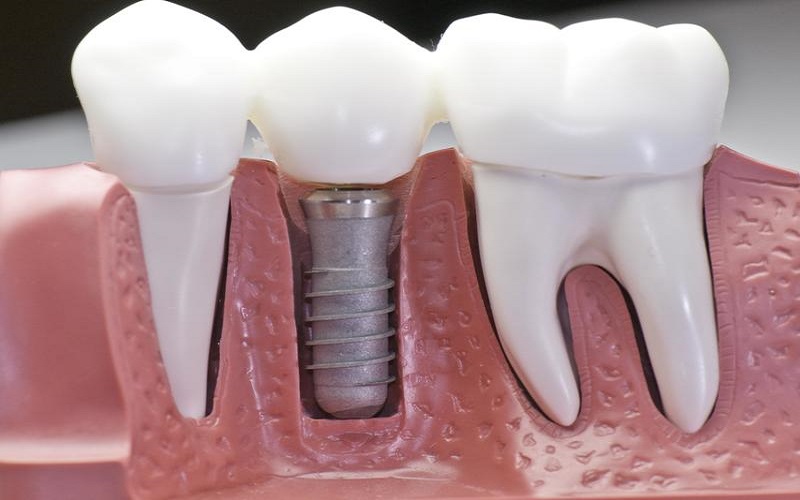 Trụ Implant phù hợp với tình trạng xương hàm