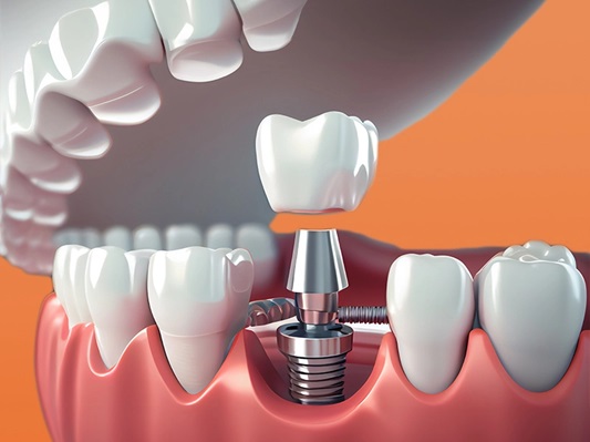 Vai trò của răng Implant trong phục hình răng mất