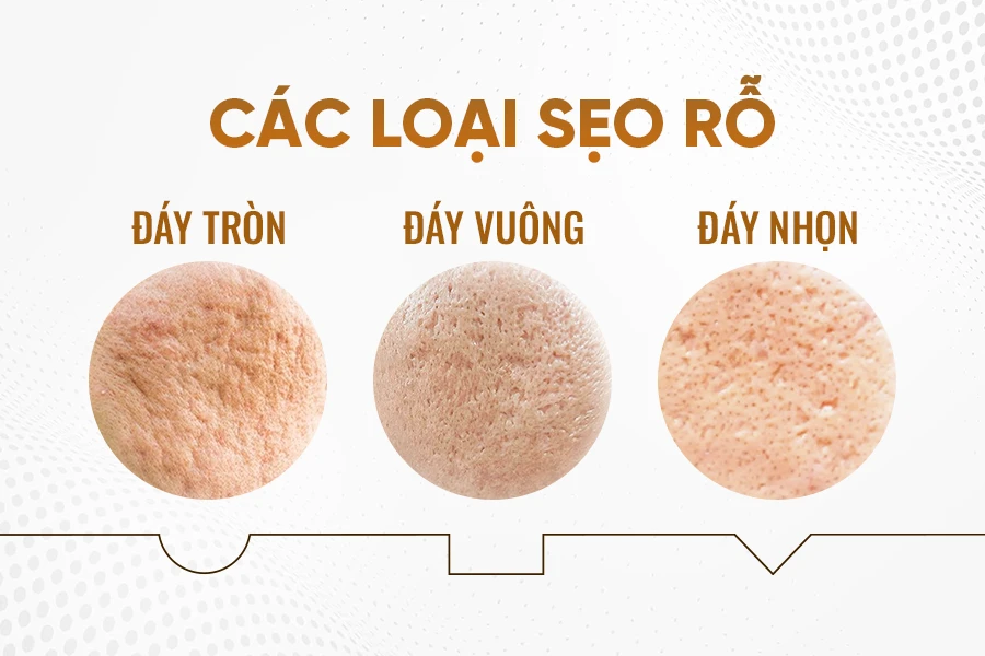 Các loại sẹo rỗ