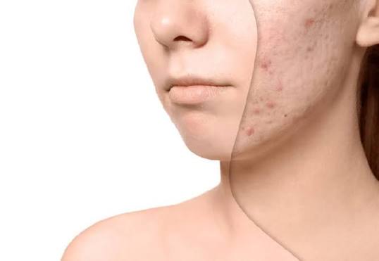 Cách ngăn ngừa sẹo mụn