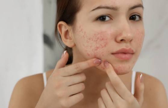 Dùng tay nặn mụn hay chạm vào da mặt cũng là nguyên nhân gây sẹo mụn