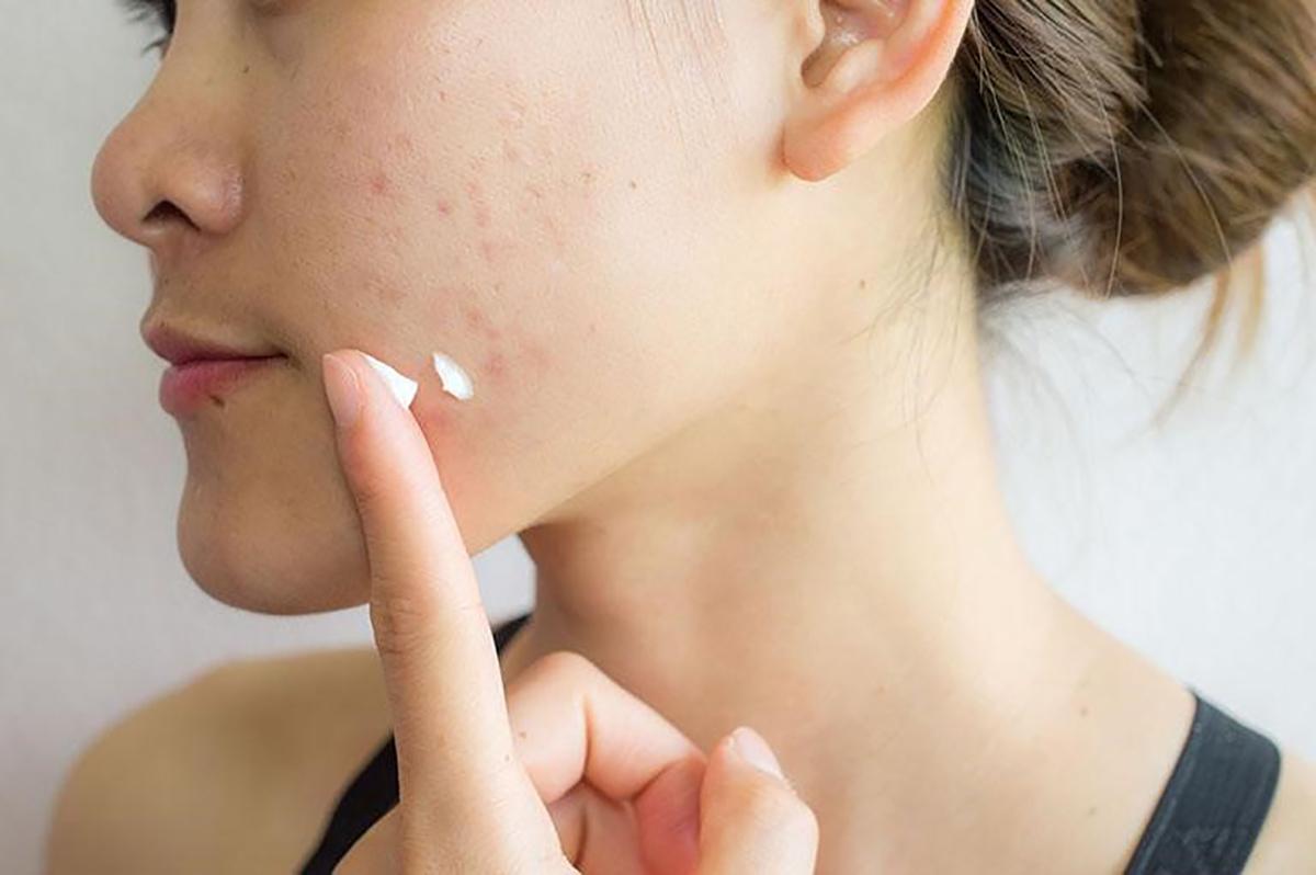 Phòng ngừa sẹo rỗ